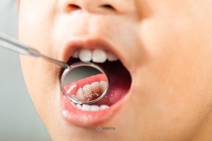 소아 치과치료②｜과잉치 발치는 어떻게? 관련 이미지 2