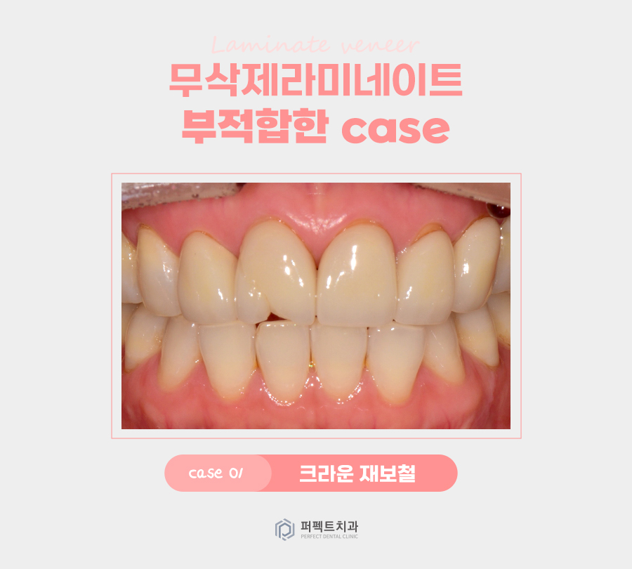 최소삭제, 무삭제 라미네이트가 적합하지 않은 경우는? 관련 이미지 2