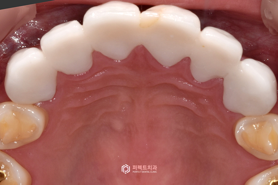 보철치료, 10년 후에는 교체를 해야한다?🤨 관련 이미지 3