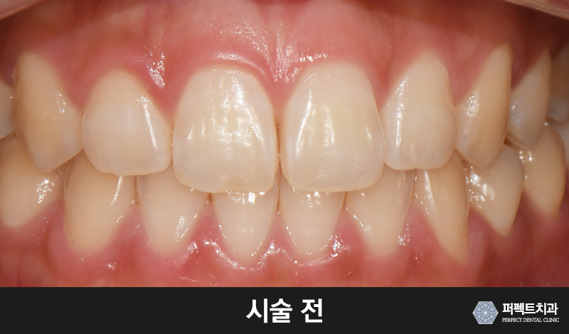 치과, 앞니 라미네이트 가격 관련 이미지 2