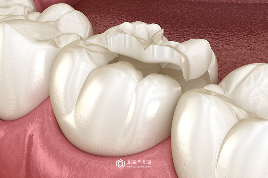 중기충치 관련 이미지 2