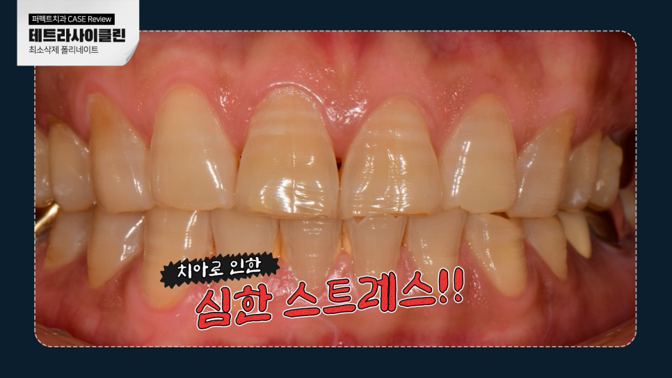 줄무늬 치아 테트라사이클린, 라미네이트vs치아미백 어떤 치료? 관련 이미지 4
