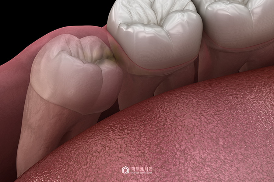 사랑니 언제 뽑아야 할까요? 관련 이미지 1