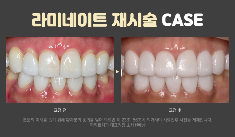 라미네이트 했는데 또 해야한다고요? 관련 이미지 3