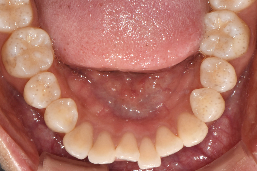 클리피씨를 이용한 부분교정, 얼마나 걸릴까? 관련 이미지 4