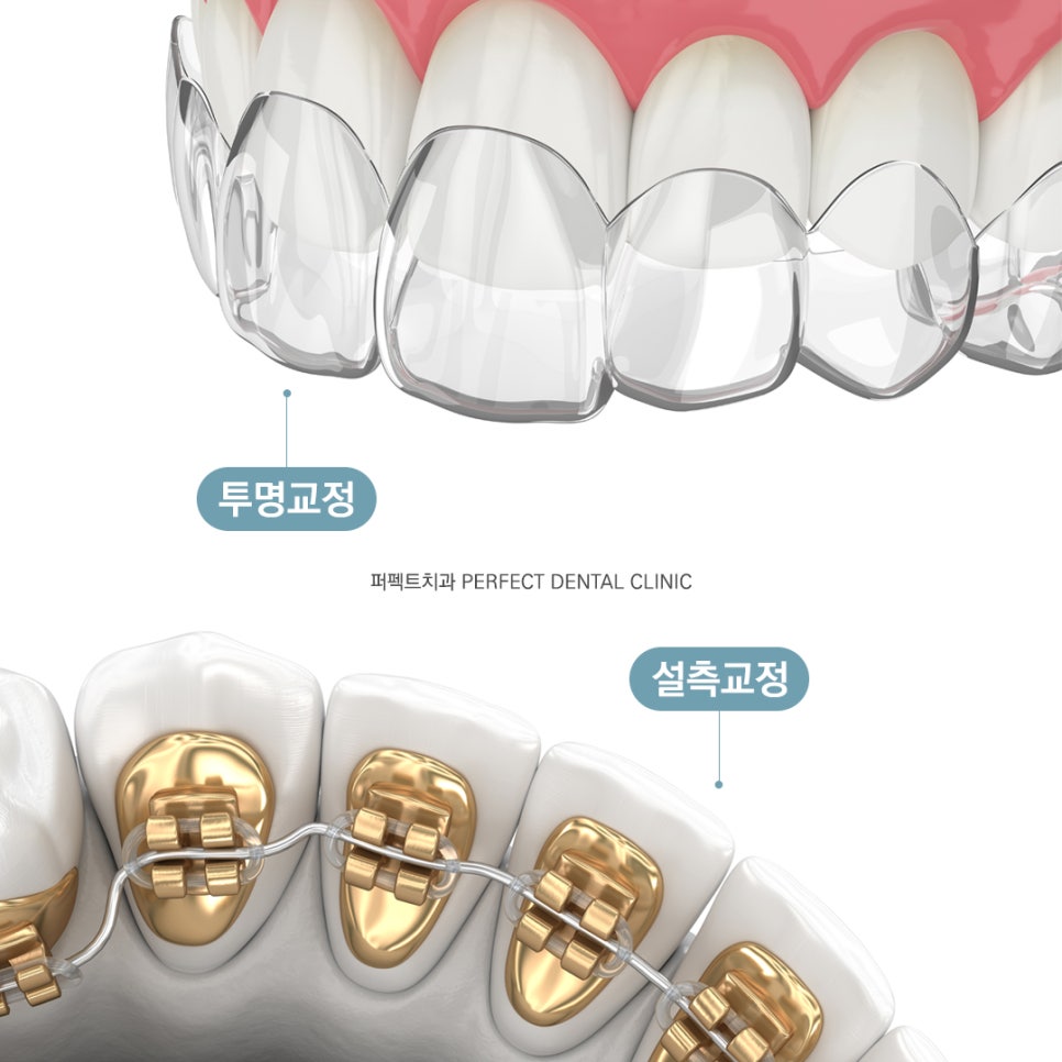 라미네이트 후 치아교정 가능한가요? 관련 이미지 2