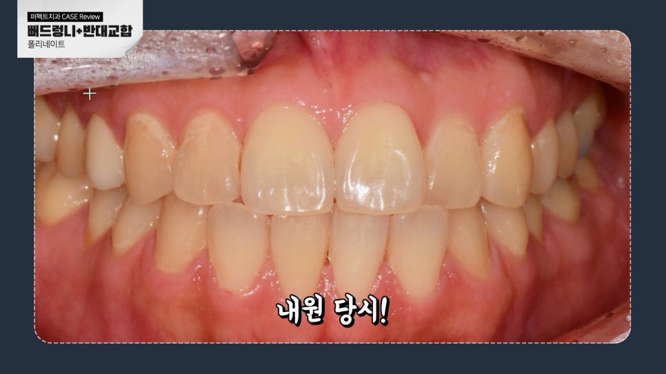 앞니 폴리네이트+치아미백 치료 관련 이미지 2