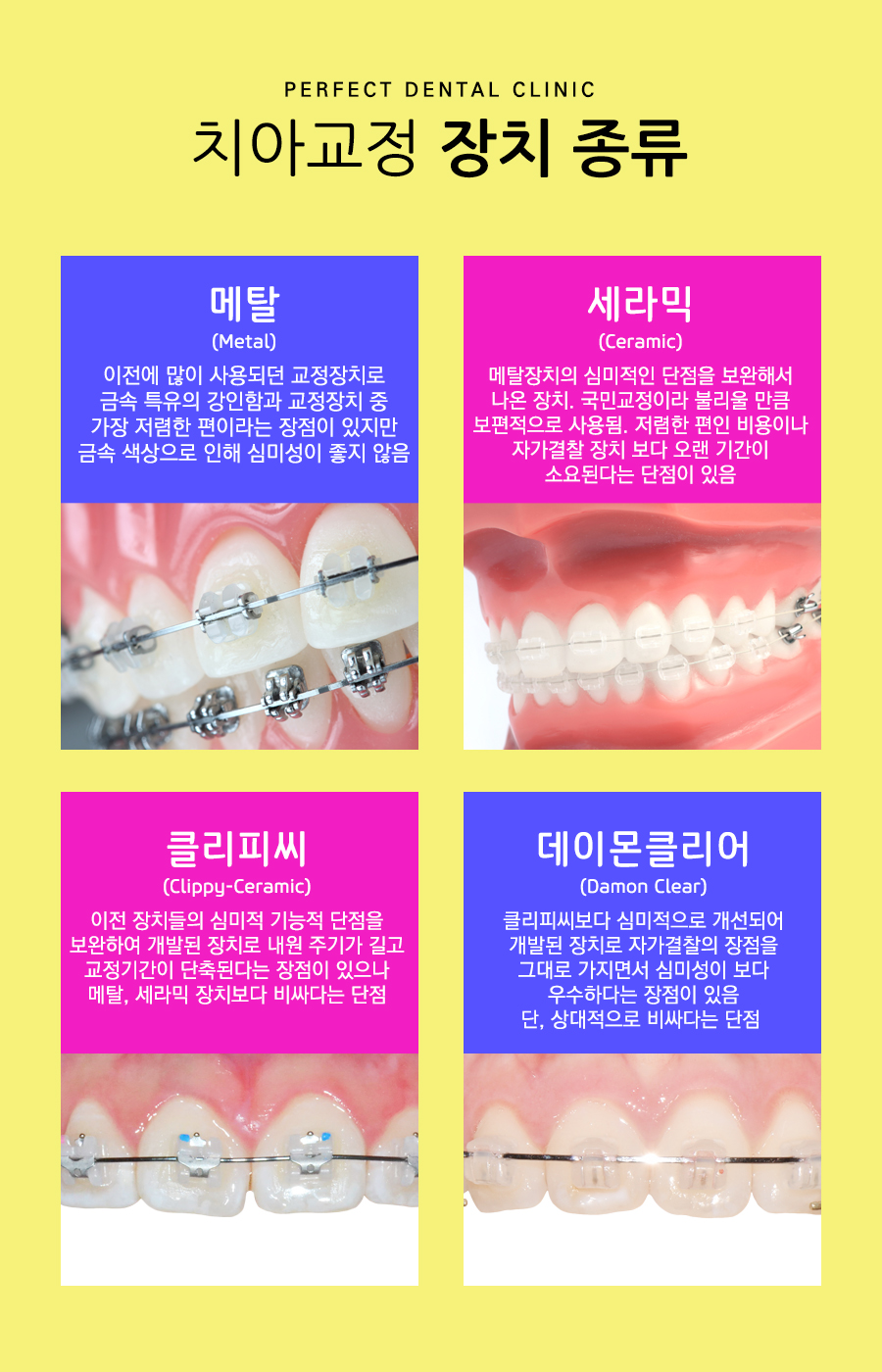 자가결찰 클리피씨전체교정 비용은 어떻게? 관련 이미지 2