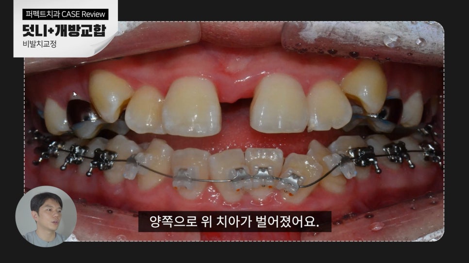 덧니+개방교합, MARPE를 이용한 비발치교정 관련 이미지 6