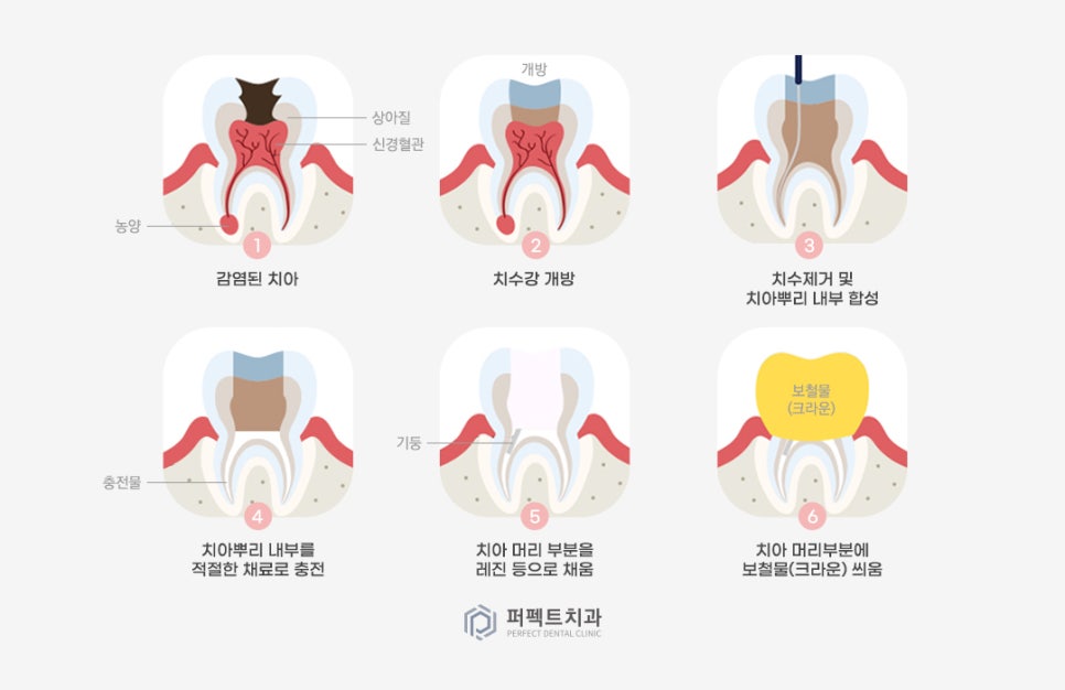 미룰수록 어려운 충치치료, 초기에 치료해요! 관련 이미지 7