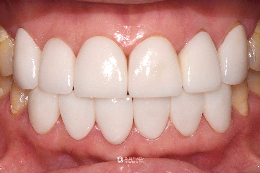 개방교합(open bite)을 라미네이트로 해결할 수 있을까? 관련 이미지 5