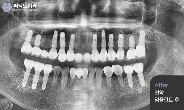 노인임플란트 건강보험 혜택 관련 이미지 4