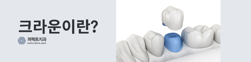 강남역치과 크라운 치료 가격 관련 이미지 2