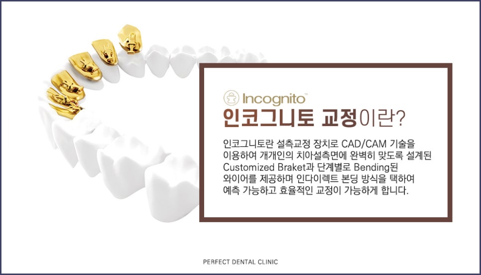 치아안쪽에 부착하는 설측교정! 관련 이미지 5