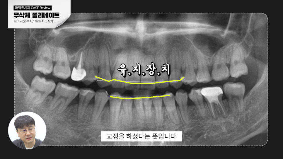 "앞니가 깨졌어요" 무삭제 라미네이트 치료CASE 관련 이미지 5
