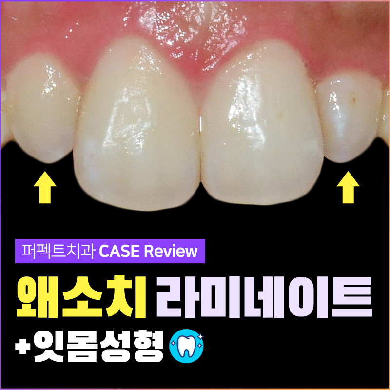 작은치아 왜소치 라미네이트 과정 공개! 관련 이미지 1