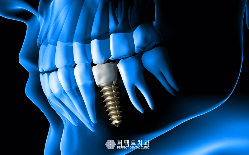 어금니 임플란트 부작용 증상 관련 이미지 2