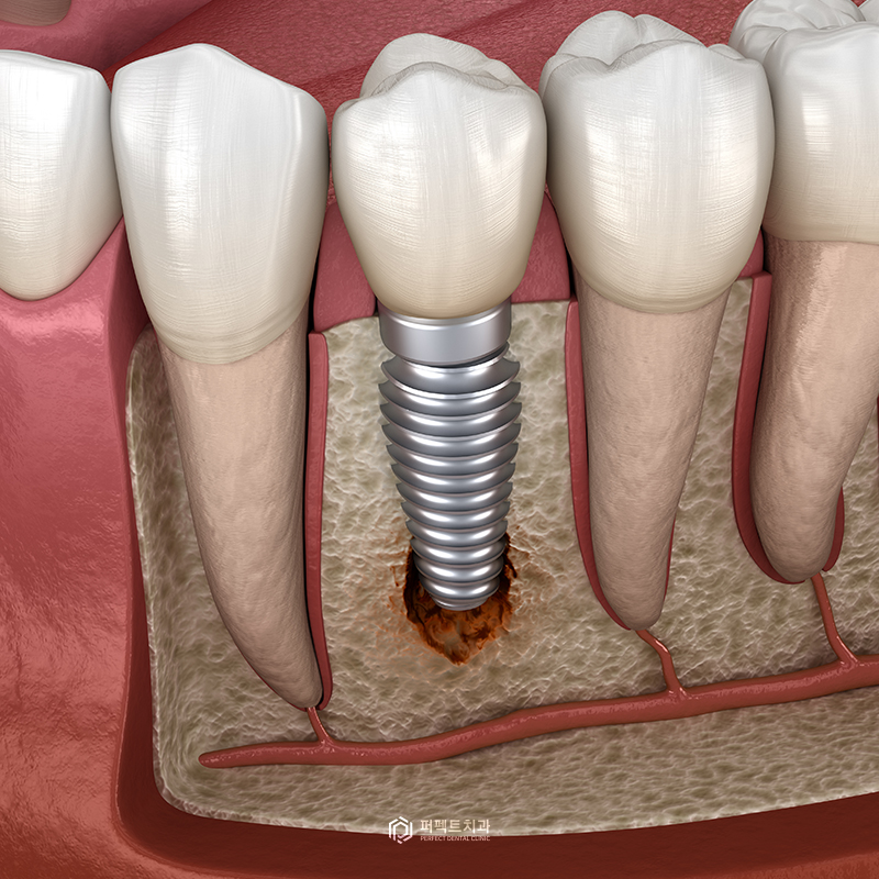 임플란트 상실로 이어질 수 있는 주위염 예방하세요! 관련 이미지 2