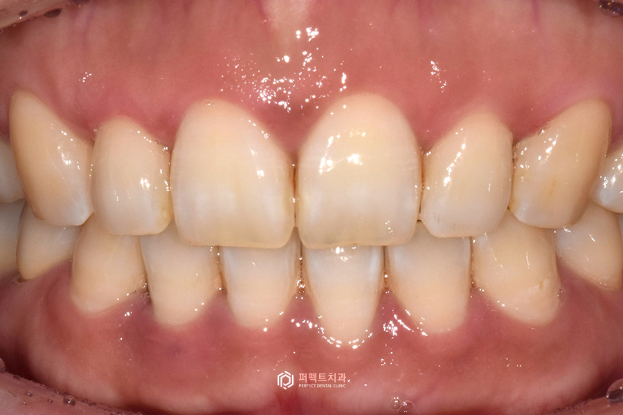 라미네이트 디자인👄｜치과의사가 고른 것vs환자가 고른 것, 어떤 걸로? 관련 이미지 4