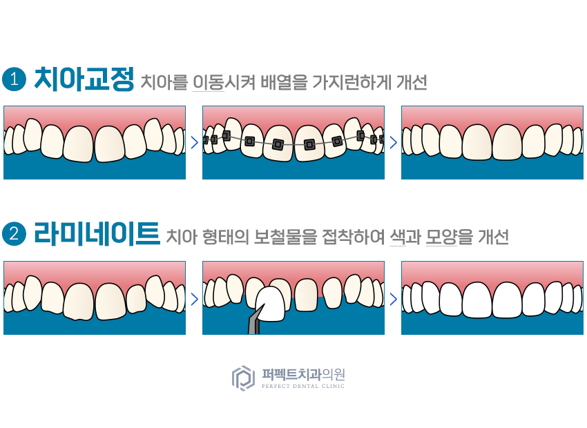 라미네이트 치료 시 참고사항은? 관련 이미지 2