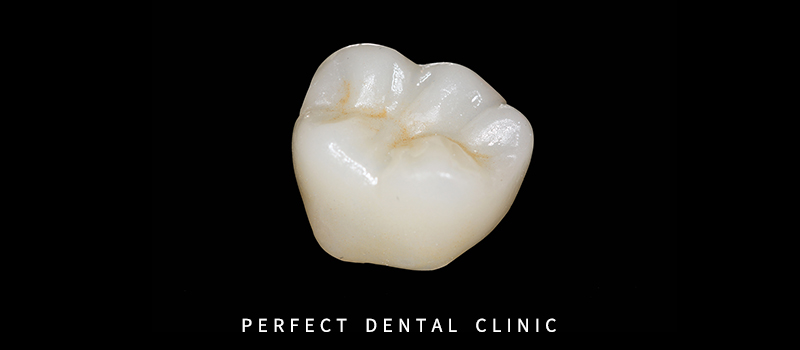 어금니 지르코니아 크라운 가격 관련 이미지 3