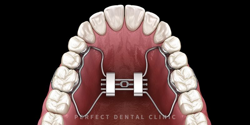 marpe 악궁확장치로 비발치교정 관련 이미지 2