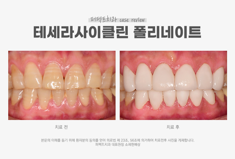 테트라사이클린 치아변색 폴리네이트 케이스 관련 이미지 6