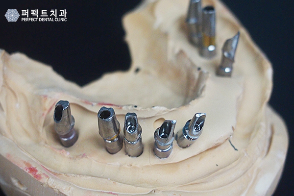 임플란트 건강보험 적용하면? 관련 이미지 4