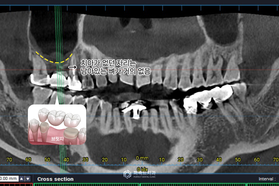 임플란트를 해야하는데 상악동에 염증이..😭 관련 이미지 4