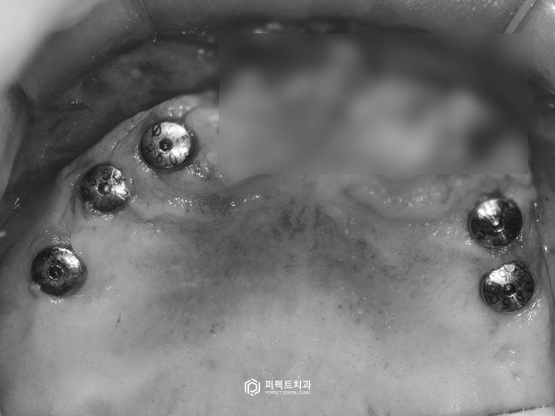 네비게이션 가이드로 전악임플란트를 20분만에? 관련 이미지 4