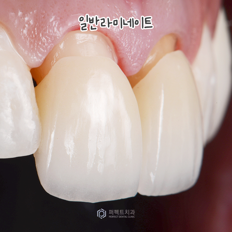 일반 라미네이트 vs 무삭제 라미네이트, 어떤 차이점이? 관련 이미지 2