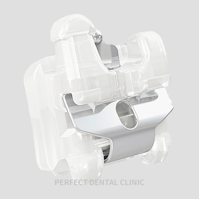치아교정 장치종류! 관련 이미지 1
