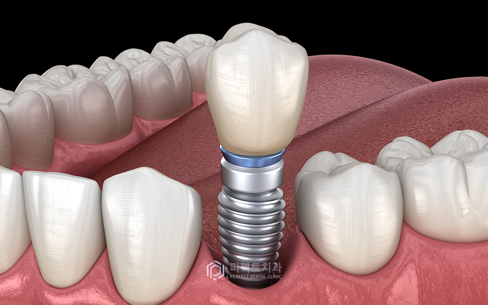 컴퓨터 분석을 통한 임플란트 관련 이미지 4