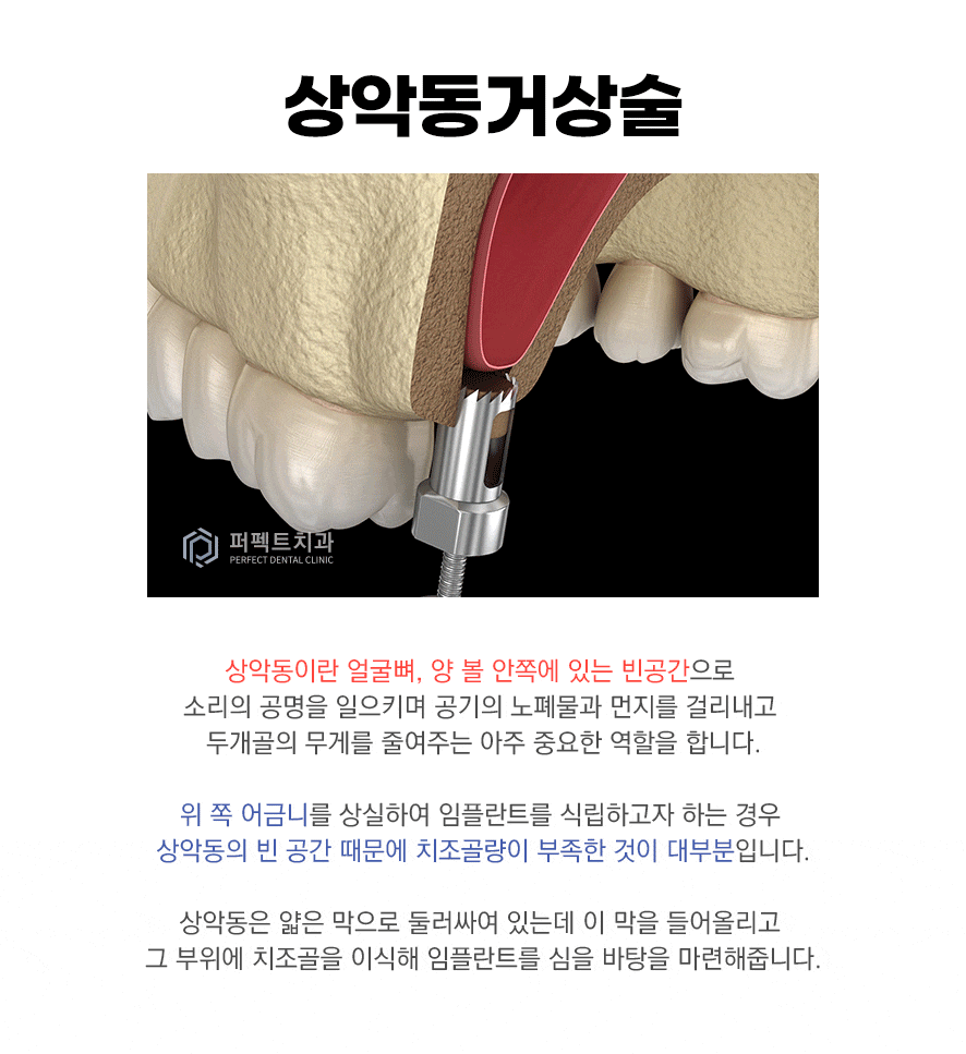 컴퓨터 분석을 통한 임플란트 관련 이미지 10