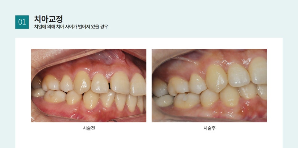벌어진 치아, 무조건 교정을 해야한다? 관련 이미지 3