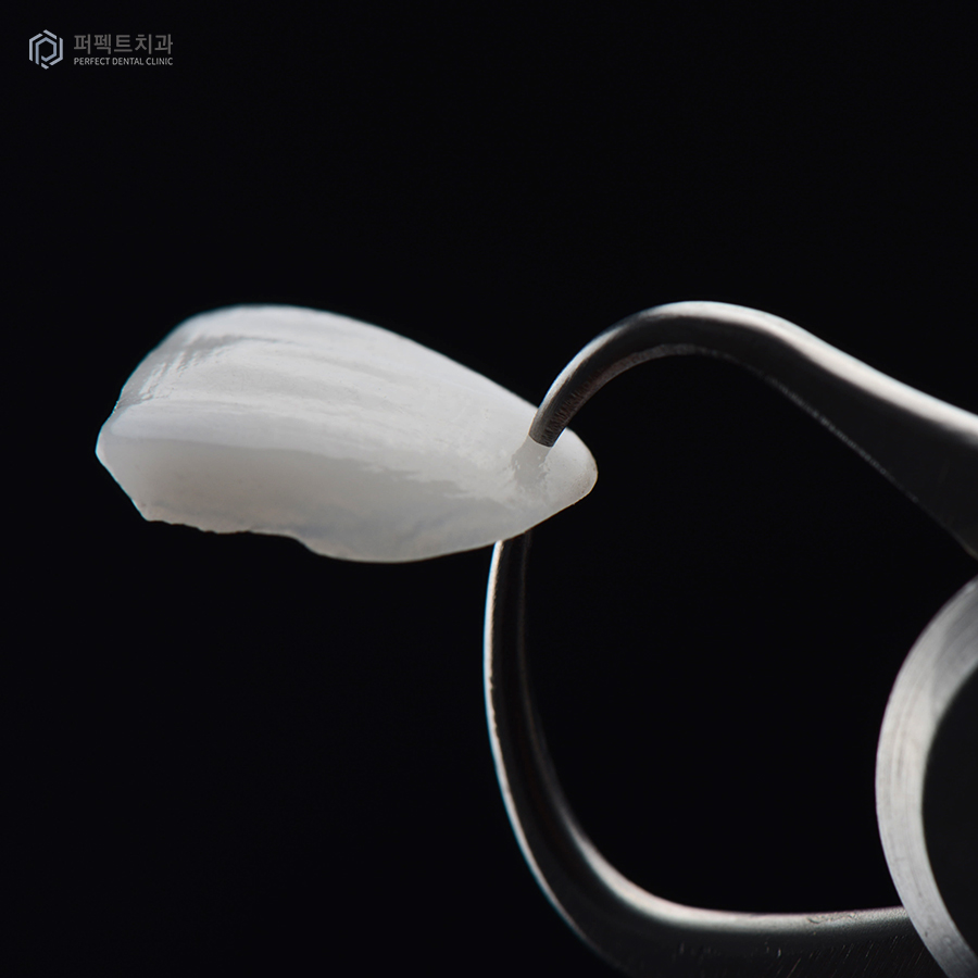 비니어와 라미네이트는 무슨 차이가 있나요? 관련 이미지 2