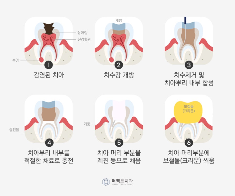 미룰수록 어려운 충치치료, 초기에 치료해요! 관련 이미지 7