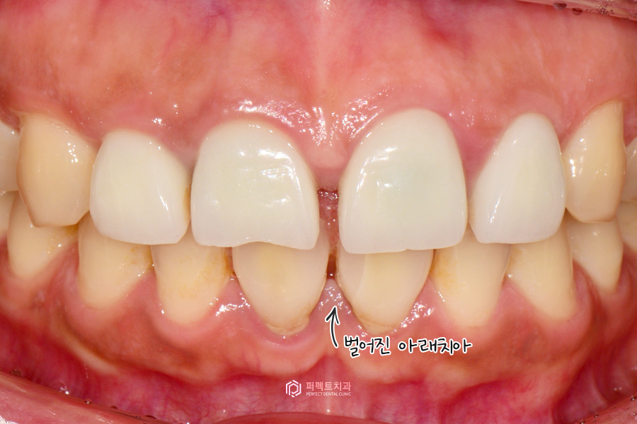 치료해도 자꾸 벌어지는 치아..😨 원인은? 관련 이미지 3