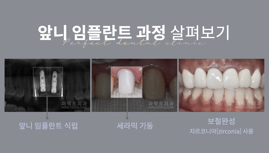 흔들리는 치아, 전체임플란트+앞니브릿지로 살리다. 관련 이미지 2