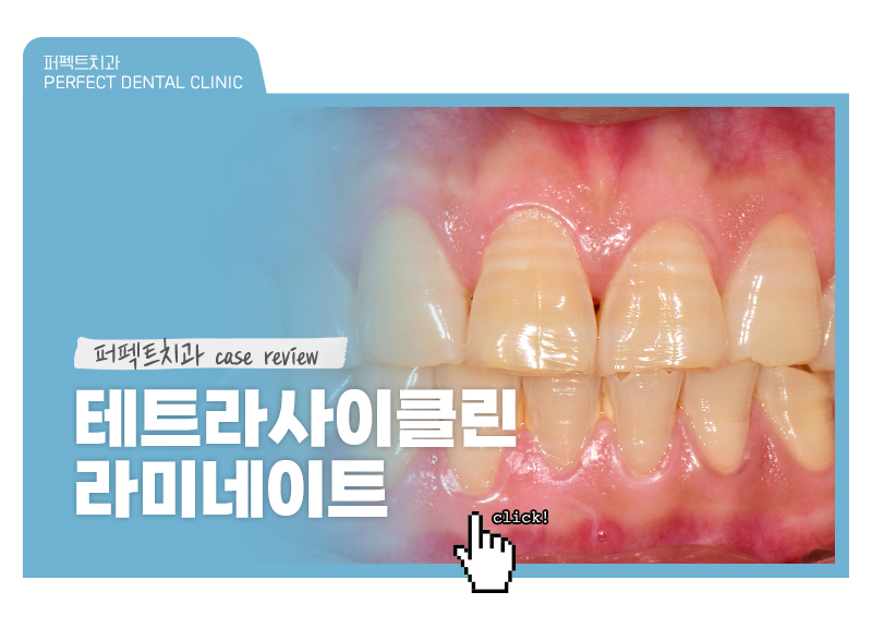 테트라사이클린 치아변색 폴리네이트 케이스 관련 이미지 1