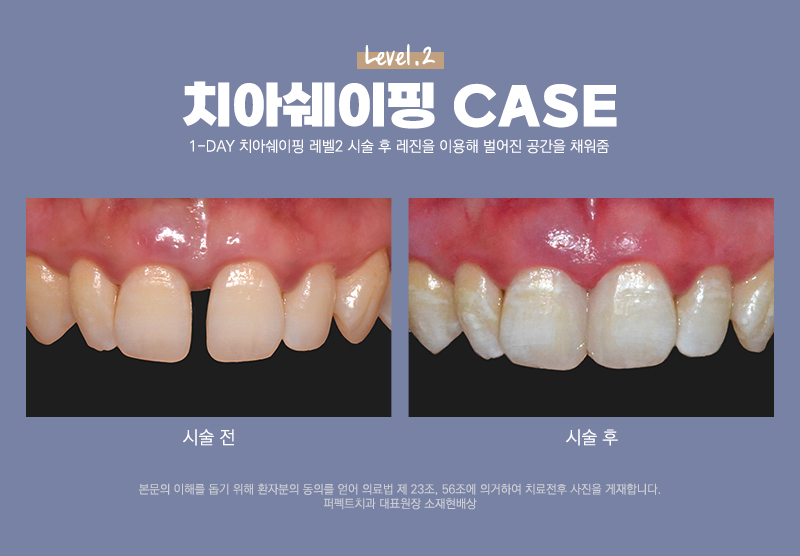 울퉁불퉁한 치아가 고민되면 치아다듬기! 관련 이미지 4