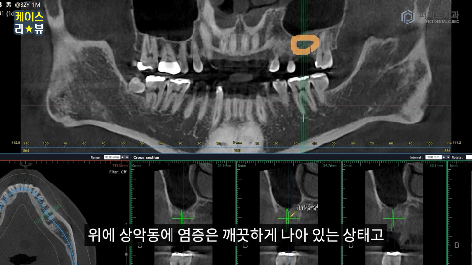 3분만에 임플란트를 할 수 있을까? 가이드임플란트 알아보기 관련 이미지 7