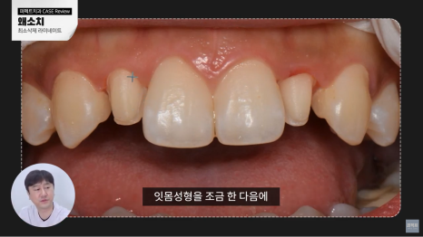 작은치아 왜소치 라미네이트 과정 공개! 관련 이미지 3