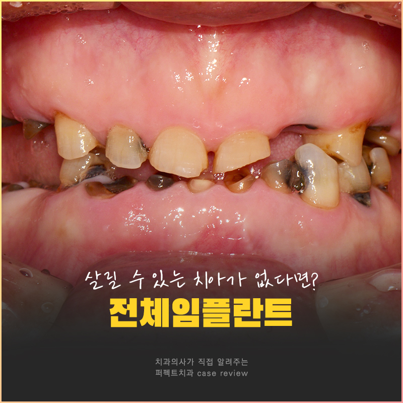 살릴 수 있는 치아가 없다면?❌｜전체임플란트 수복 관련 이미지 1
