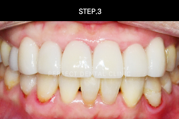 연예인라미네이트후기 관련 이미지 4