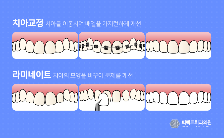 라미네이트 치료 시 참고사항은? 관련 이미지 2