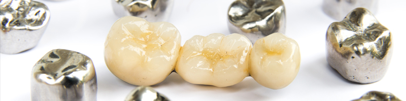 지르코니아 크라운 vs 골드크라운 vs PFM크라운 관련 이미지 4