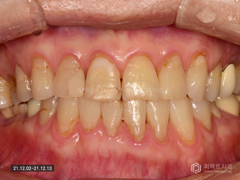 70대도 라미네이트가 가능하다구요? 관련 이미지 2