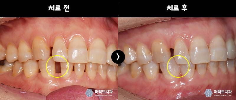 벌어진 앞니 레진으로 치료 관련 이미지 2