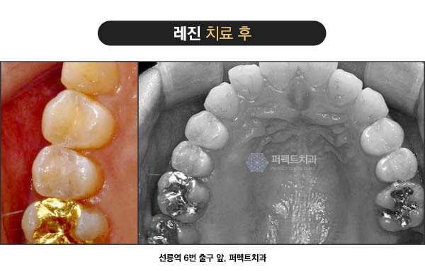 치과 충치치료비용 관련 이미지 3